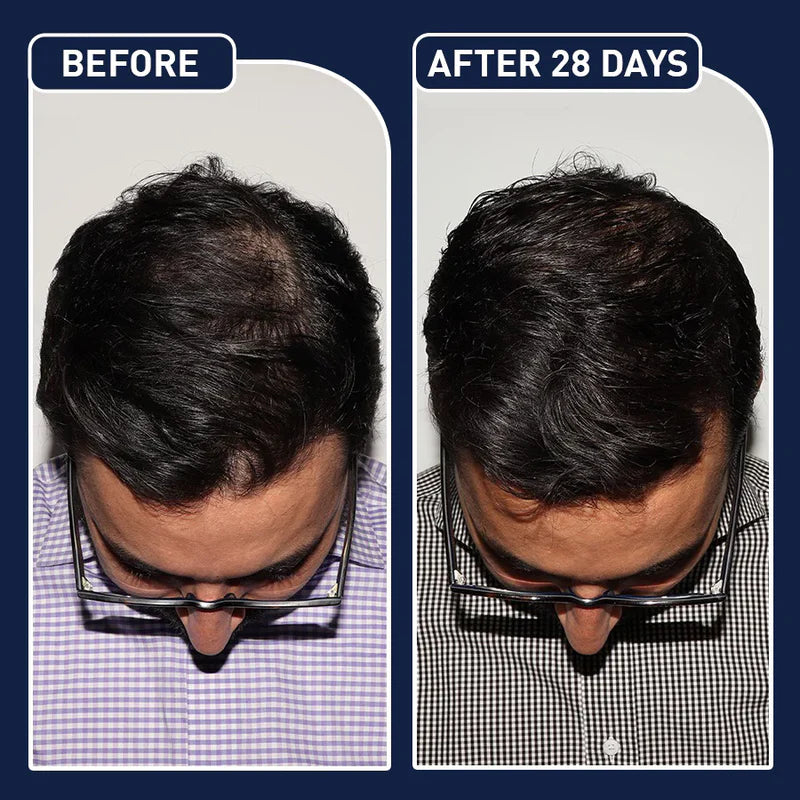 FEG Hair Growth Spray For Both Men & Women - FDA Approved - Made in USA